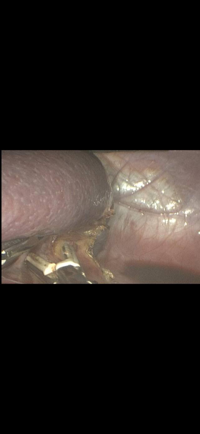 الطحال المستاصل من طفل بالمنيا